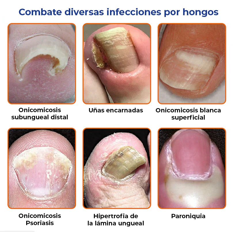 ELIMINA LOS HONGOS DE LAS UÑAS EN 5 DÍAS Y EVITA QUE APEREZCAN PARA SIEMPRE