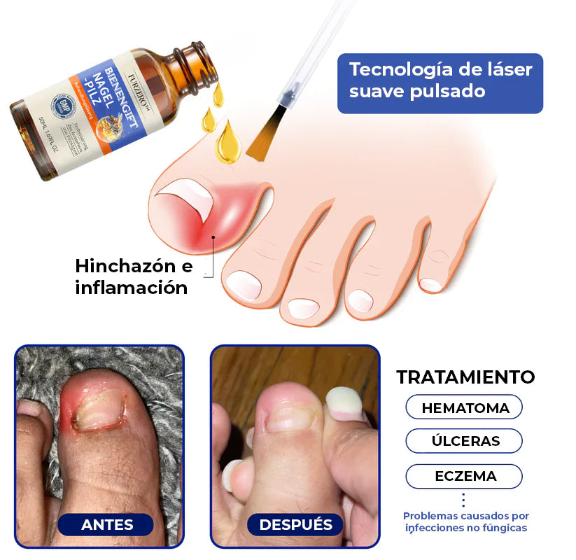 ELIMINA LOS HONGOS DE LAS UÑAS EN 5 DÍAS Y EVITA QUE APEREZCAN PARA SIEMPRE