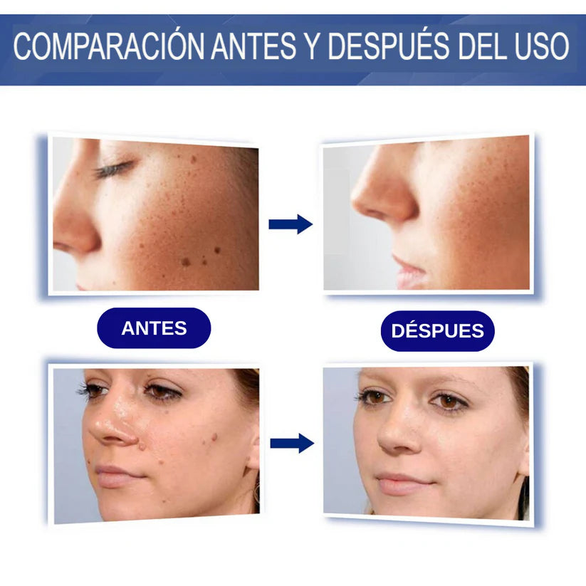 GEL WARTREMOVER ELIMINA VERRUGAS, LUNARES Y MANCHAS DE TU PIEL-TOP EN VENTAS