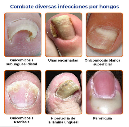 ELIMINA LOS HONGOS DE LAS UÑAS EN 5 DÍAS Y EVITA QUE APEREZCAN PARA SIEMPRE