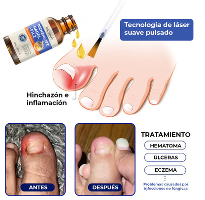 ELIMINA LOS HONGOS DE LAS UÑAS EN 5 DÍAS Y EVITA QUE APEREZCAN PARA SIEMPRE